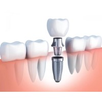 Dental Implants
